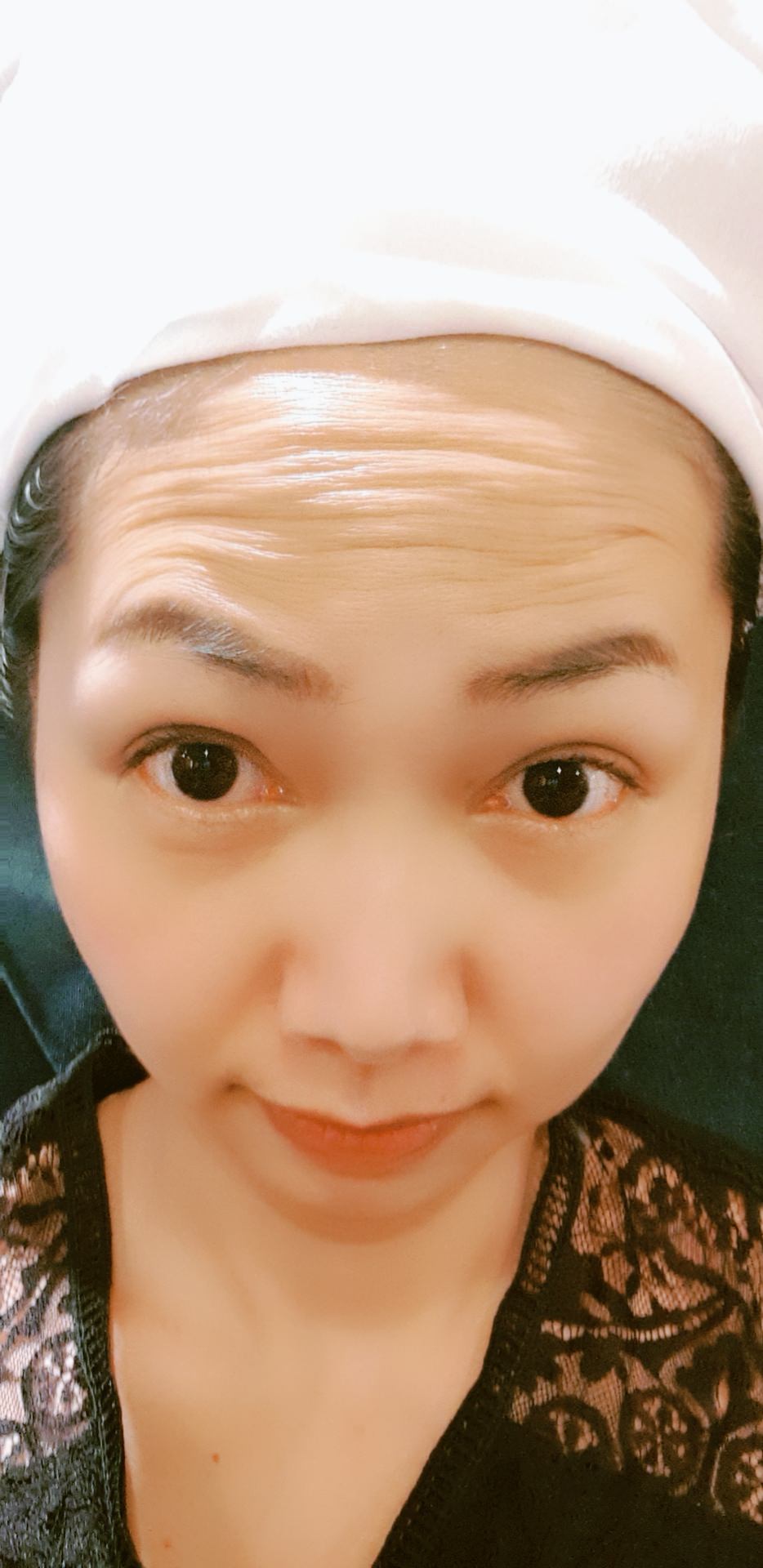 抬頭紋消失術 彩虹肉毒除皺瘦小臉 ┃中山淨妍醫美診所 - 第1張圖