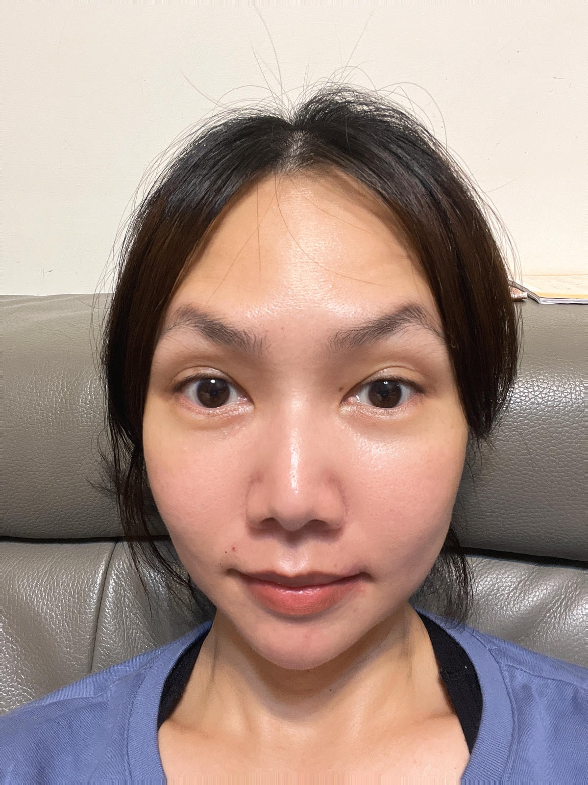 抬頭紋消失術 彩虹肉毒除皺瘦小臉 ┃中山淨妍醫美診所 - 第2張圖